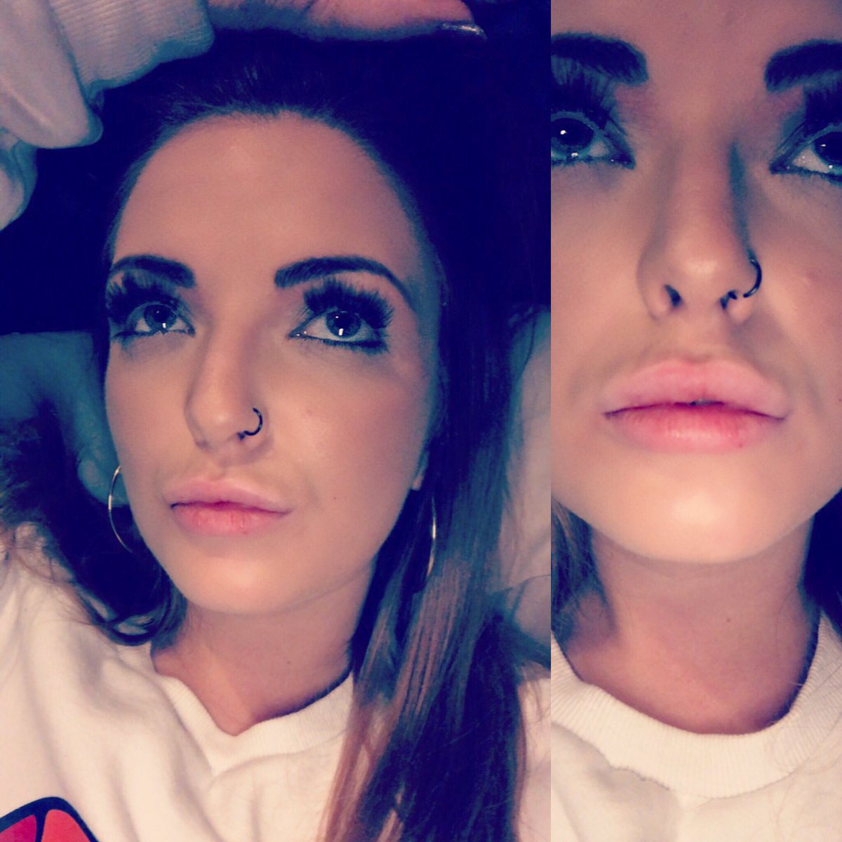 3beelily's tweet photo. Cheeky 0.8ml top up, slightly swollen 🙄🙈💉👄 #lipfillers #1.8ml https://t.co/Rs3maO6yjb