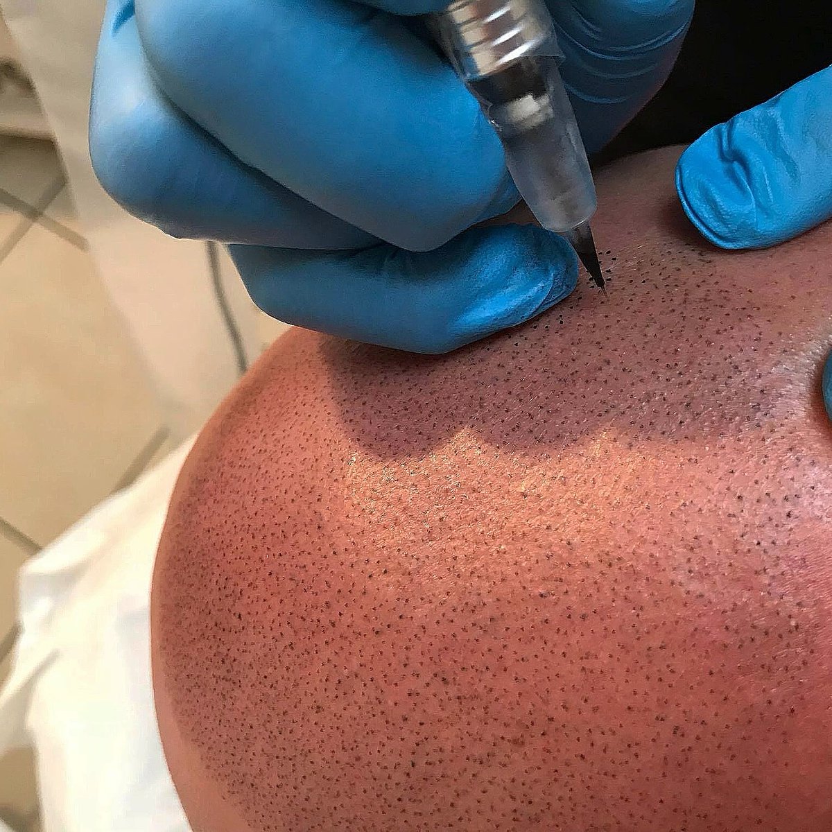Scalp Micro UK tweet media