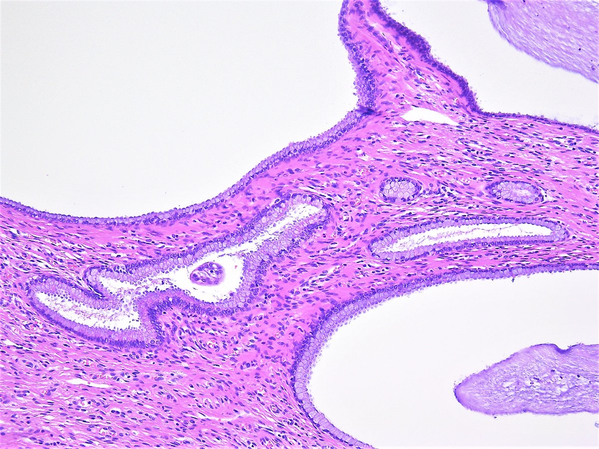 Pathology Walker Auto Tweet Bot در توییتر Nabothian Cyst Of Uterine Cervix Uterus Hysterectomy He Stain Https T Co Yrbowy2t5g