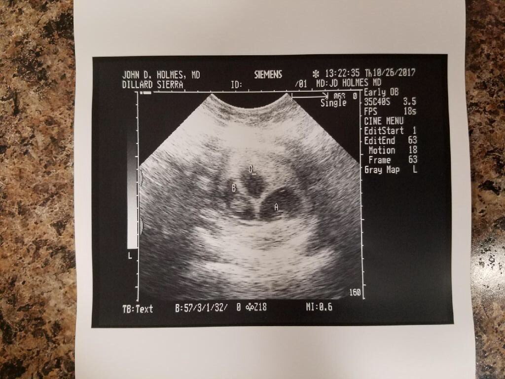 anniidill's tweet photo. Since I’m just so excited I’ll post it here on twitter too, I’m gonna be an aunt to TRIPLETS!!!💛👶🏼👶🏼👶🏼 https://t.co/VXJXp8ZohY