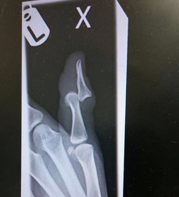 BBCWYS's tweet photo. 😱NEWS: Huddersfield Town's Paul Ogden an injury doubt after breaking his thumb while playing football with his lad #htafc #PrayForOggy 😂 https://t.co/RXIOZQ9ZAe