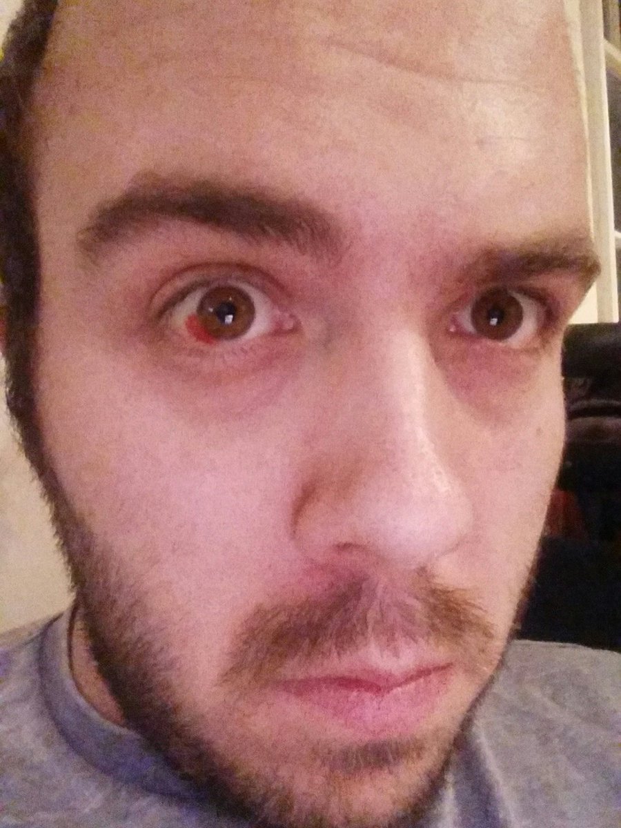 mattacus91's tweet photo. #eyeupdate slowly healing https://t.co/IgJdE9mTim