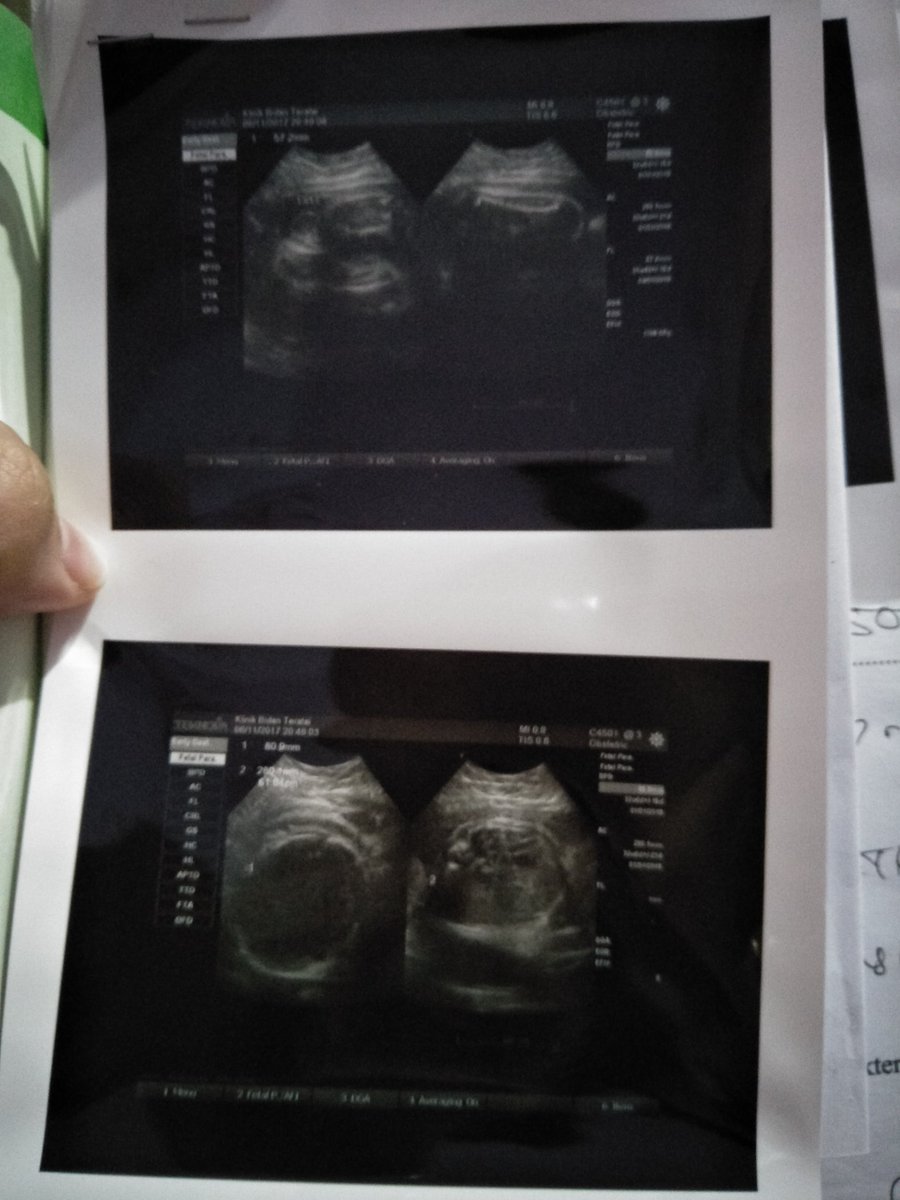 chacha060688's tweet photo. 34 week 👶 https://t.co/hNIxVQzZMX