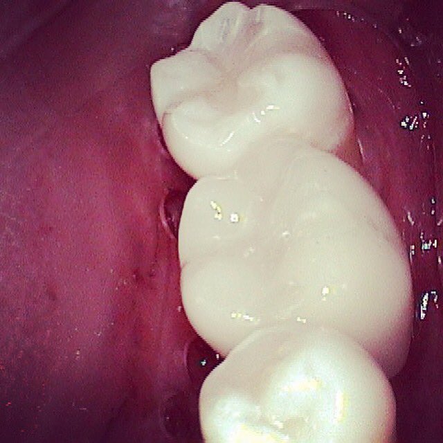 SonoranDental's tweet image. Straumann implant retained crown delivered like a dream! #cerecdoctors #sonorandental #straumannimplants