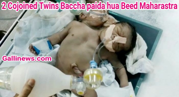 gallinews's tweet photo. 2 #Cojoined #Twins Baccha paida hua Beed #Maharastra @Mumbaikhabar9 @ANILGALGALIRTI @bilal_motorwala
https://t.co/xXZpiVV1oJ https://t.co/nmRtGCoYHU