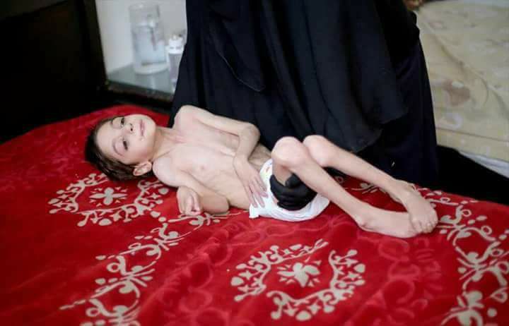 asaadhanna's tweet photo. Rahaf is 8 years old, and now she is only 10 kg. Rahaf is gonna die in #Ghout because #AssadbesiegesGhouta 
#HelpRahaf https://t.co/ND7RmjuJPf