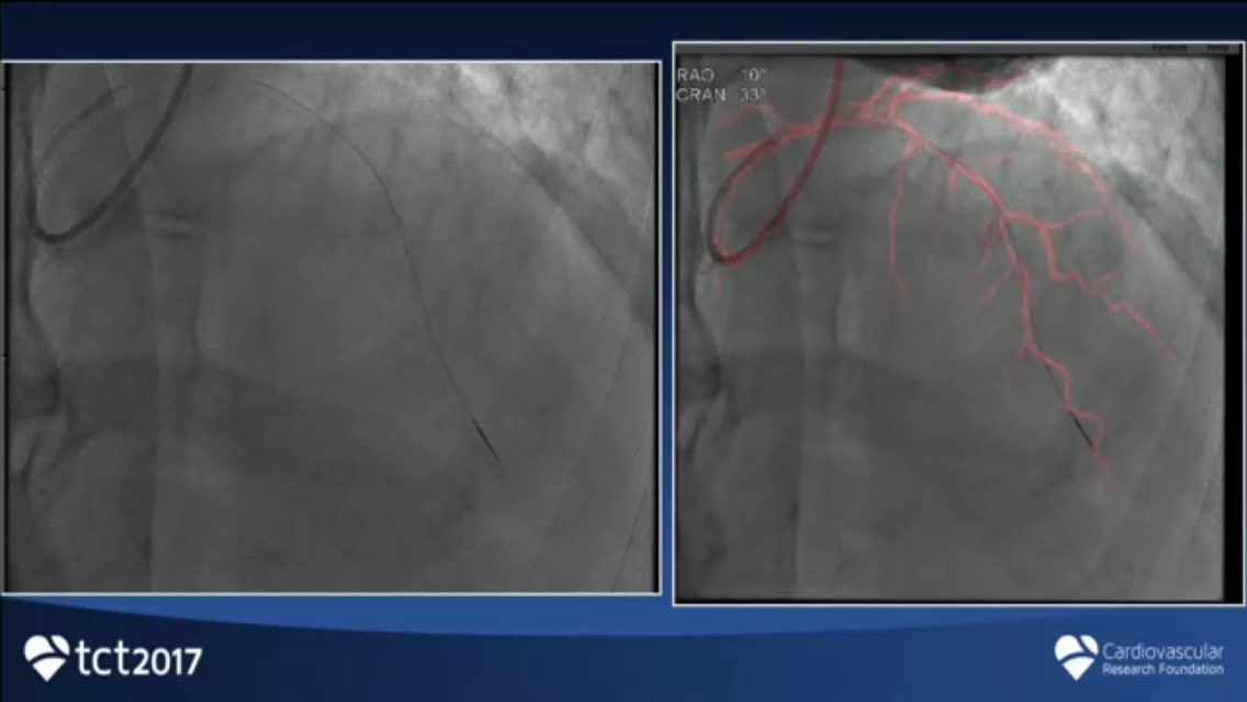 Learning about new technologies for PCI with Coronary road mapping  #TCT2017