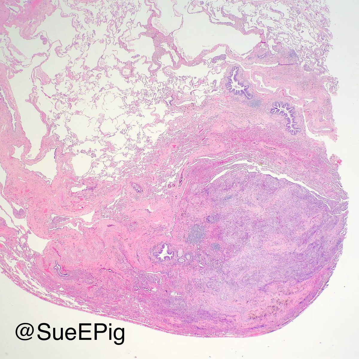 SueEPig's tweet photo. 35M with nodules and cysts in upper lobes. What other diseases can mimic pulmonary Langerhans cell histiocytosis?? #pulmpath #hhpath #CD1a https://t.co/fGFCEnVvjp