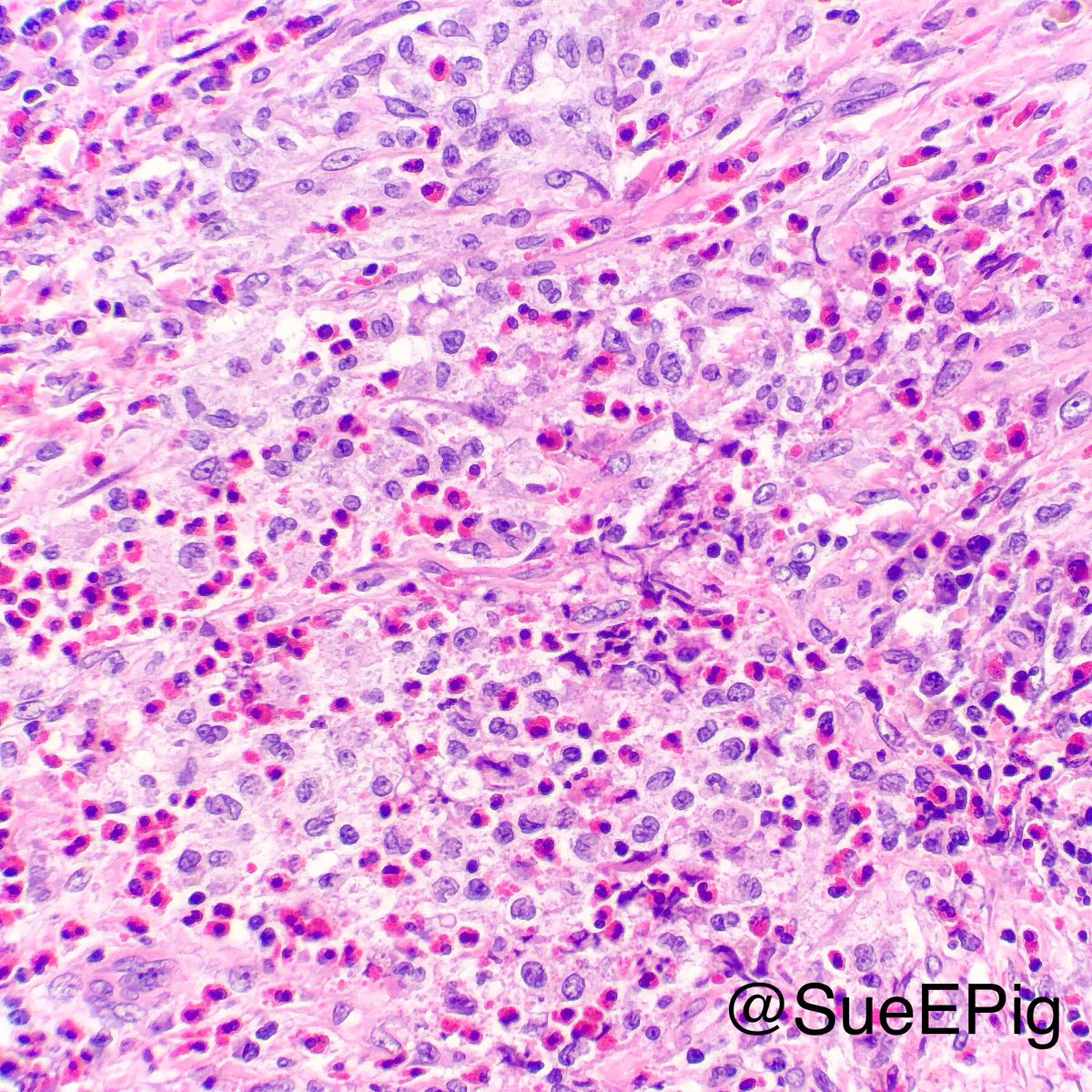 SueEPig's tweet photo. 35M with nodules and cysts in upper lobes. What other diseases can mimic pulmonary Langerhans cell histiocytosis?? #pulmpath #hhpath #CD1a https://t.co/fGFCEnVvjp