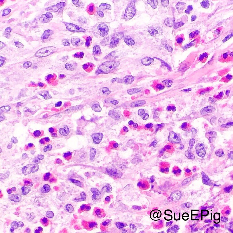 SueEPig's tweet photo. 35M with nodules and cysts in upper lobes. What other diseases can mimic pulmonary Langerhans cell histiocytosis?? #pulmpath #hhpath #CD1a https://t.co/fGFCEnVvjp