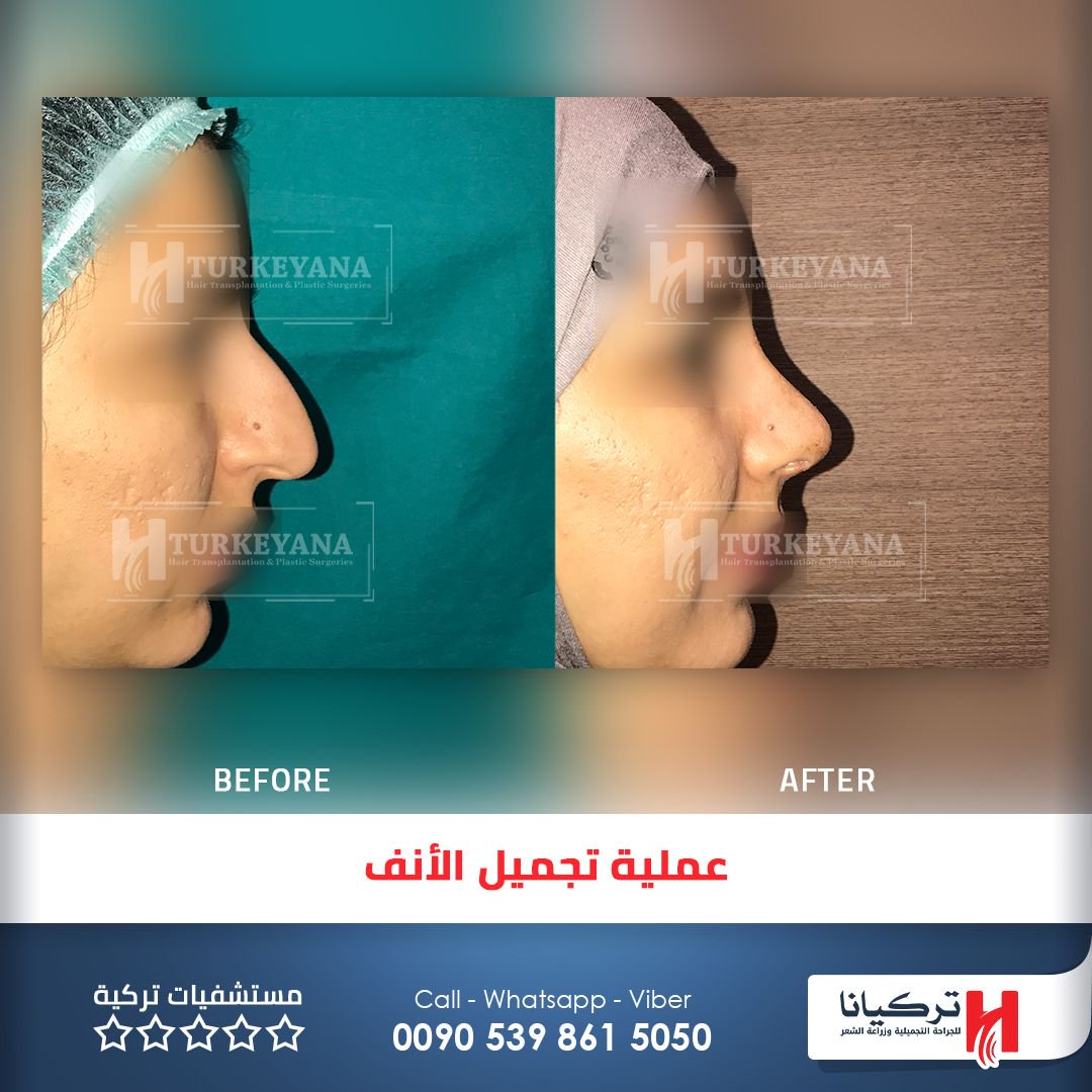 turkeyanaclinic's tweet photo. #تجميل_الأنف_في_تركيا #تركيانا #تجميل_الأنف #انحراف_الوتيرة_الأنفية #تركيا #اسطنبول #nose_job #rhinoplasty #rhinoplasty_in_turkey #turkeyana https://t.co/ZKpWZsZNKJ