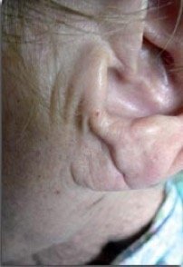 CardioOnline's tweet image. Quel est ce signe ? #CardioQuiz #Curiosité #cardiologie