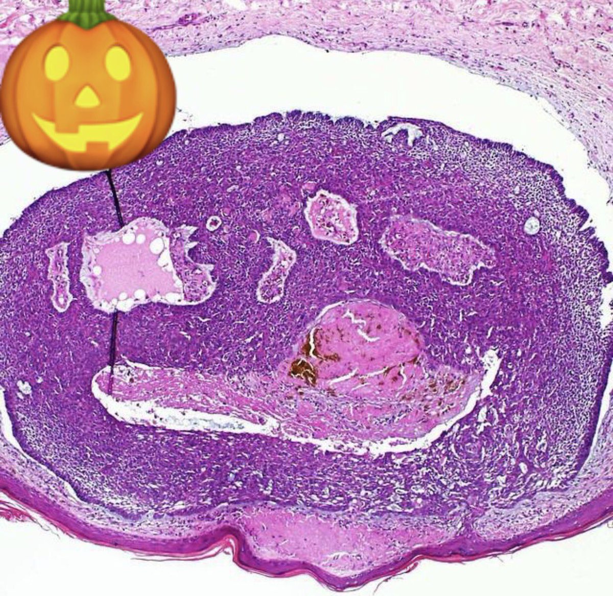 JCGarcesPath's tweet photo. Happy #halloween to all #dermpaths @msldermatopato @jmgardnermd @pembeoltulu @draeosina https://t.co/vilwpS7wjy