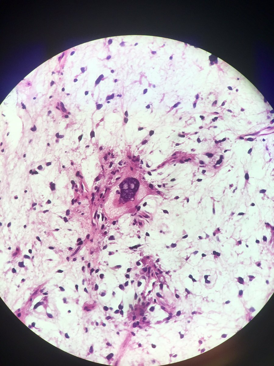 Neuygn's tweet photo. Scary to have one of these staring at you today! #HappyHalloween! @PathoPictures @Pathologista @tim_dalfonso @FKhaniPath https://t.co/IVxa4Pf9Kw