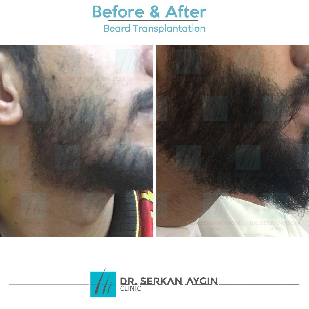 DrSerkanAygin's tweet photo. What to expect from a beard transplant operation?
In 12 months you can get #backtobeard like our patient! #beforeandafter https://t.co/WgAi8stlo0