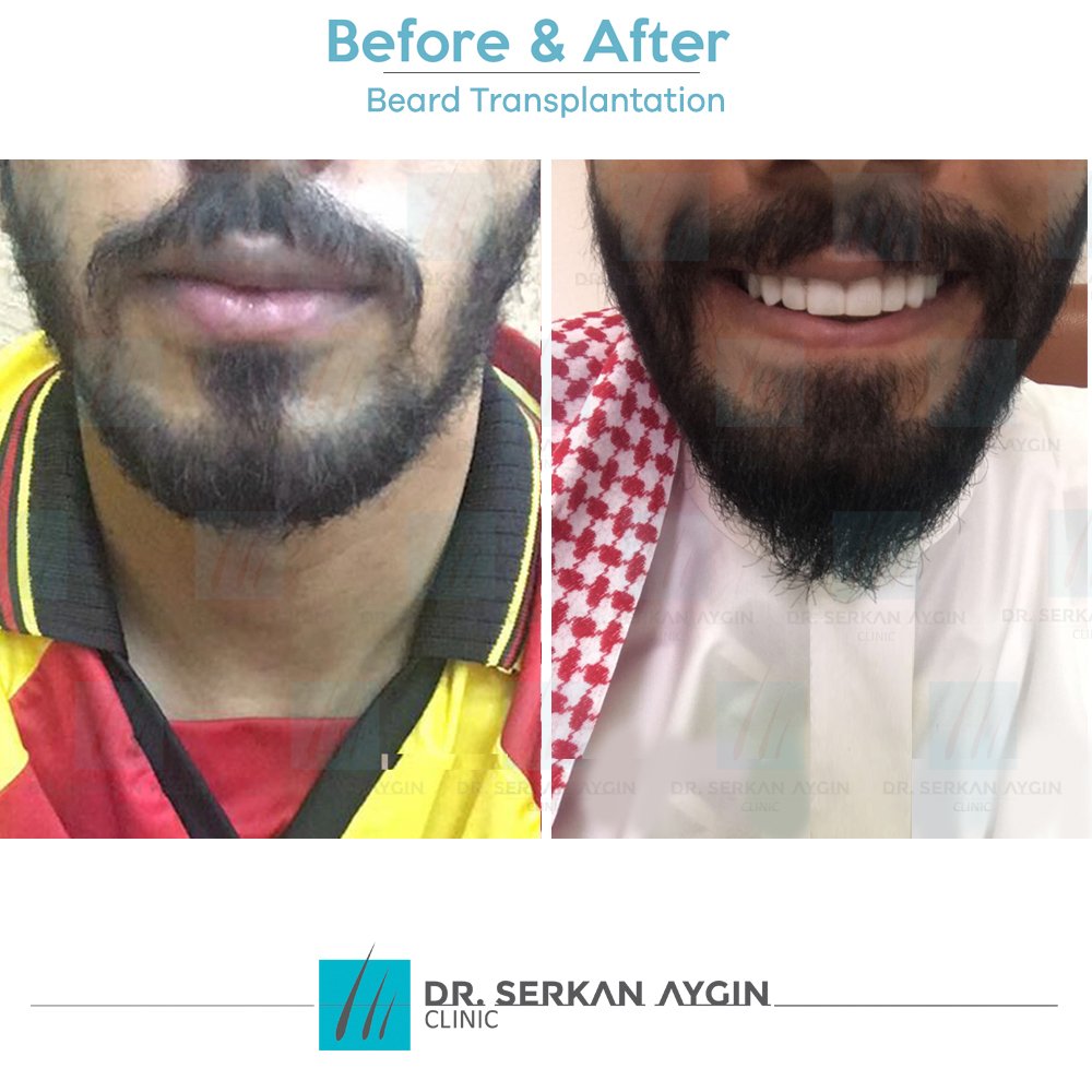 DrSerkanAygin's tweet photo. What to expect from a beard transplant operation?
In 12 months you can get #backtobeard like our patient! #beforeandafter https://t.co/WgAi8stlo0