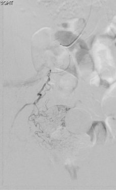 robsheridanavir's tweet photo. #transradial prostate artery #embo - improves pts w BPH quality of life! Pt leaves #irad w a tiny hole in wrist @STREAMpae @MGHIR1 @AlexCVIR https://t.co/WHICML0Id6