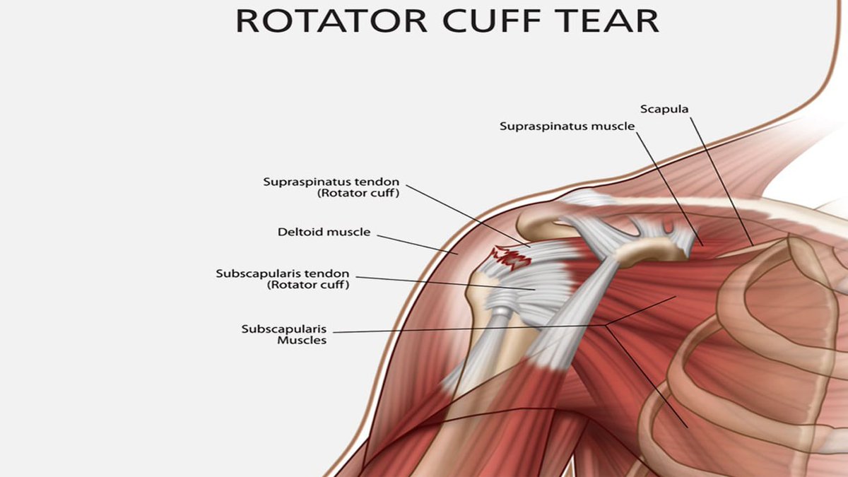 Early rotator cuff surgery yields good long-term outcomes. #rotatorcuff -  sciencedaily.com/releases/2017/…