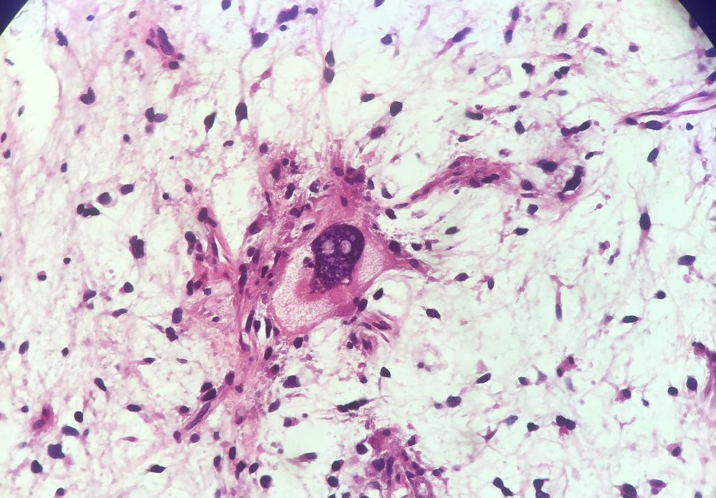 Neuygn's tweet photo. @LisaRooperMD Literally a "ghost" cell. Unlike other ghost cells. #happyhalloween https://t.co/5fIFrWgKQy
