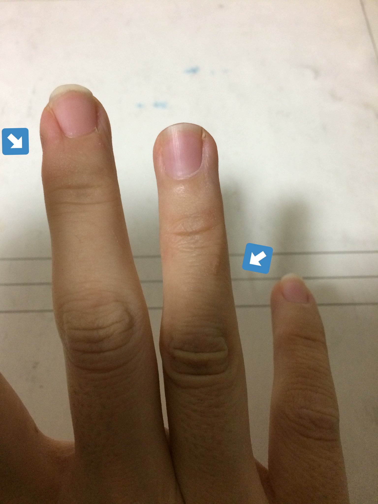 永田 光起 En Twitter よく絵を描く人とか勉強よくする人はペンだこできたりするじゃないですか 自分は力加減が普通と違うのか何故か出来ないのが微妙にコンプレックスだったんですが 中指のペン支えるとこむしろ凹んでますよね この度 ペンだこらしいものが