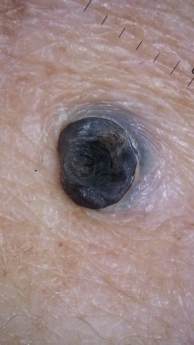 dermapaz's tweet image. Cansado de las espinillas? 
Nosotros tenemos los mejores tratamientos para extraerlas y evitarlas. 
Agenda tu cita.