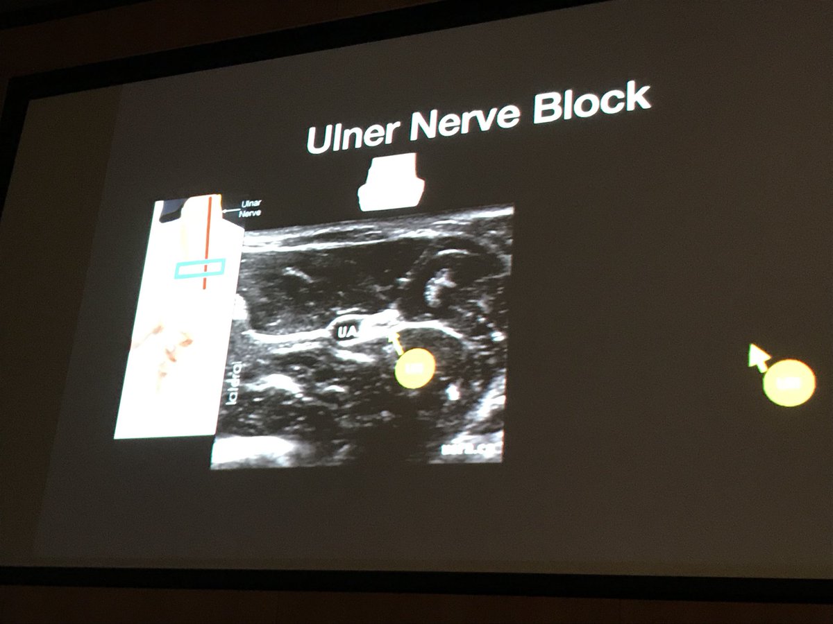 emuss_uk's tweet photo. This is how the Ulnar nerve looks on #POCUS made easy and simple by @EmergOmBur @RCEMLearning @drshahrul80 @esemultrasound @TrEmatus @iceman_ex @jrobi09 @lauraellen115 @RickMiles16 @WINFOCUS @jiconnoly @RBuhumaid @hopeful9613 #emussconf3 https://t.co/HB6kG06Lrw