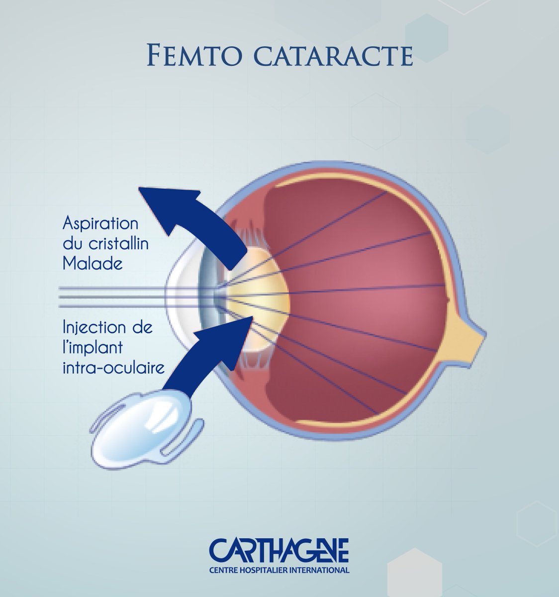CCarthagene's tweet photo. #Femto_cataracte
#révolution #microchirurgie #cataracte #femtoseconde #laser
#ophtalmologie #Tunisie #Ihct #Carthagène https://t.co/nJobW08izD