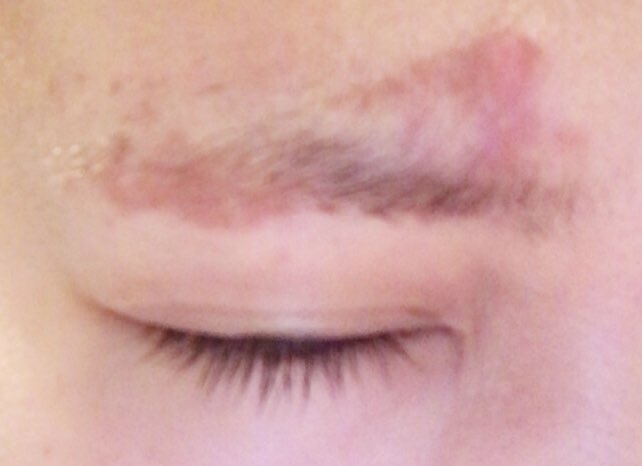 Shoko Pa Twitter 眉毛脱色 したらただれた ってインスタのストーリーズでも騒いでたんだけど いまこんなん いままでそんなこと無かったのに 両眉こんな感じでただれてて ファンデでも消えなくて さいあく パッチテストの大切さを知った 早く治って