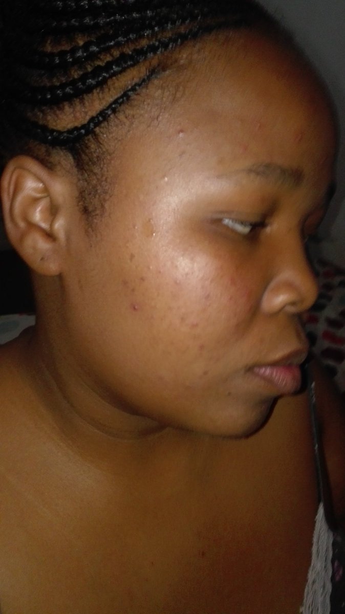 Precious_bleta's tweet photo. #GirlTalkZA . #periodpimples. How do I stop them https://t.co/deNL9PvHp7