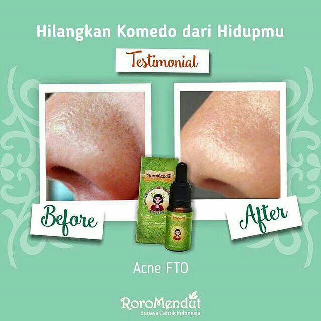 Saya menjual SERUM ANTI A... seharga Rp130.000. Dapatkan produk ini hanya di Shopee! shopee.co.id/tiwantiolshop/… #ShopeeID