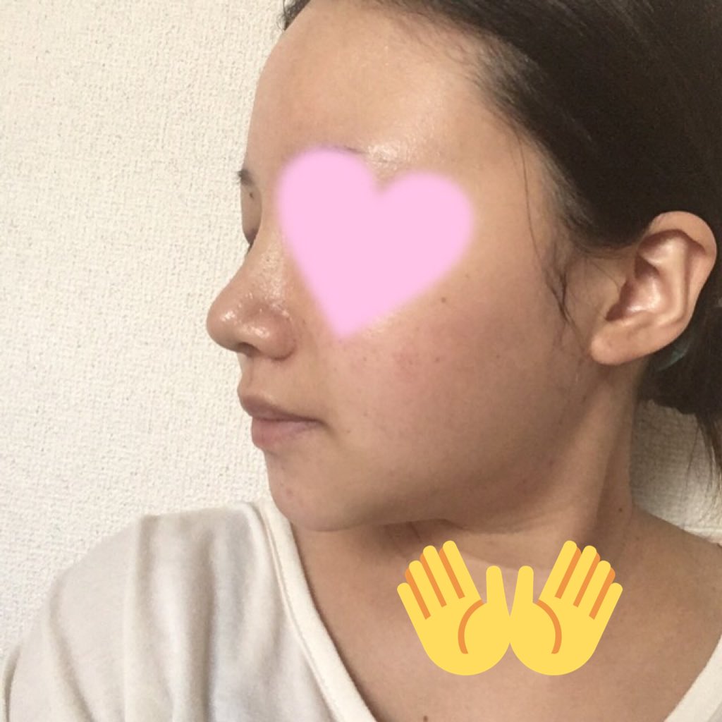 みかん No Twitter 術後8日目 昨日より鼻先の腫れが 治った 横から見た時に鼻先 だけ高い 目の下の黄色い痣 顎下の痣 はまだある T Co Hlslgdukc0 Twitter