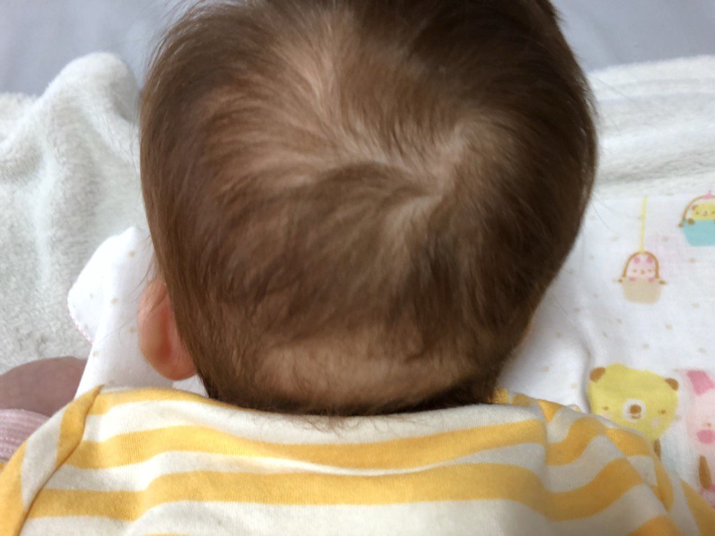 呂九 على تويتر 最近抜け毛が激しい ドン引きするほど抜ける 娘の抜け毛もヤバイ せっかくきれいな茶髪なのに後頭部がチリチリ ハゲ 寝てる時間多いから仕方ないんだけどさ W 産後抜け毛 生後4ヶ月 茶髪 後頭部ハゲ 呂九 على تويتر 最近抜け毛が激しい ドン引きするほど抜ける 娘の抜け毛もヤバイ せっかくきれいな茶髪なのに後頭部がチリチリ ハゲ 寝てる時間多いから仕方ないんだけどさ W 産後抜け毛 生後4ヶ月 茶髪 後頭部ハゲ