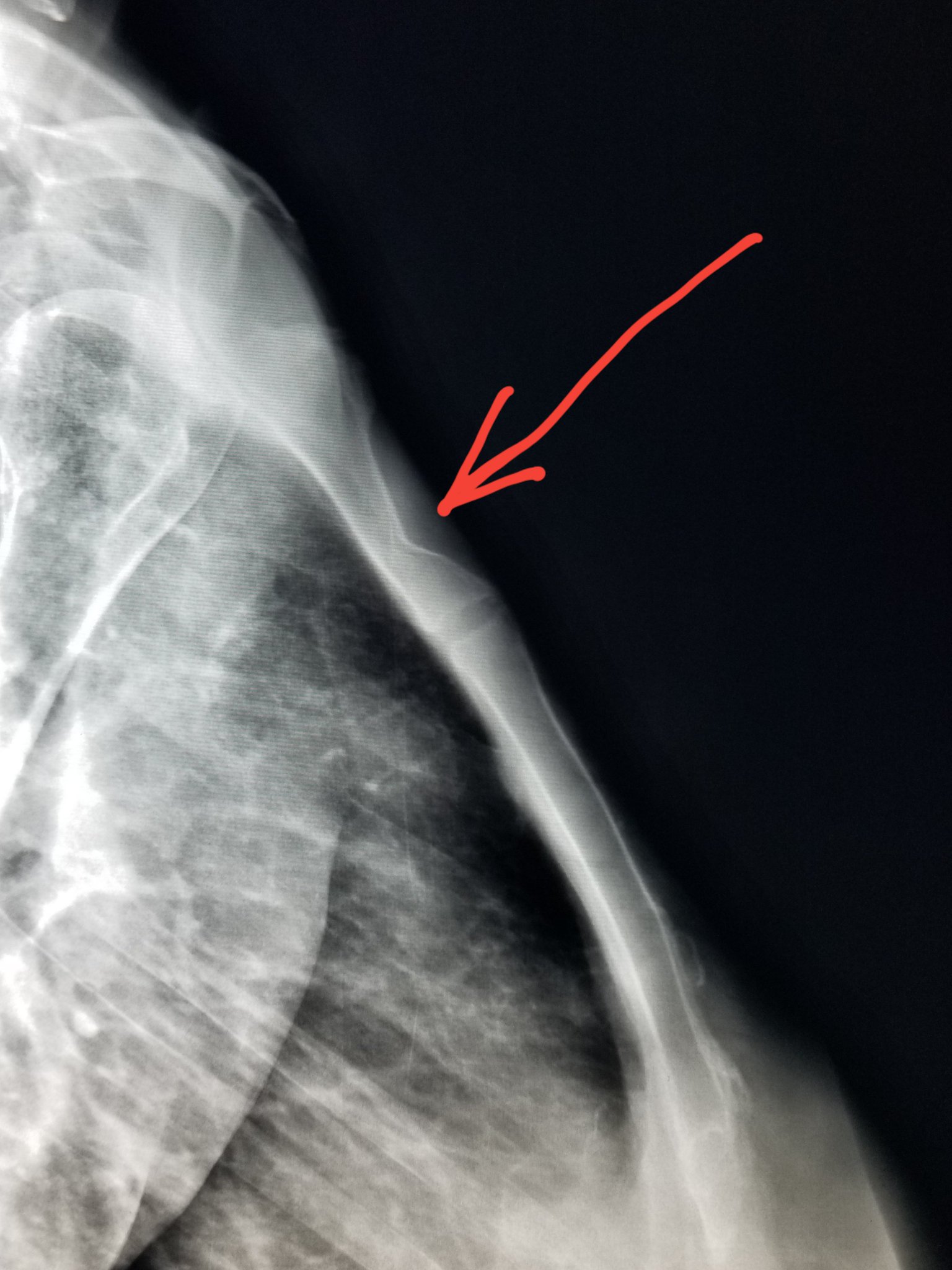 NBrowardRadiologists on Twitter "Sternal Xray car accident shows a