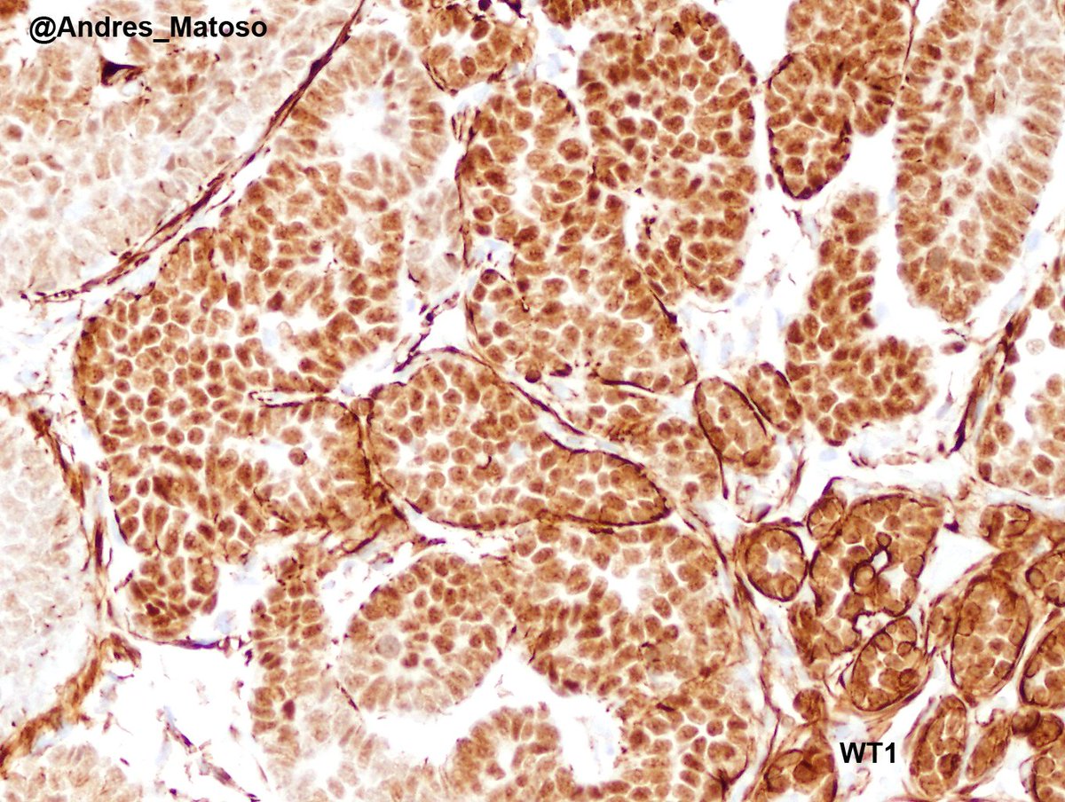 Andres_Matoso's tweet photo. Testicular teratoma gone bad. Primitive looking somatic malignancy. See glomeruloid structures. PanCK should prompt WT1 staining. "Nephroblastoma arising from Teratoma" #GUpath #pathology https://t.co/9Bzx6OTRj6