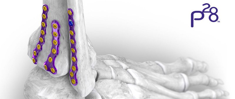 asianhhm's tweet image. Paragon 28® Increases its #RobustAnkleFracture Offering - Gorilla® #AnkleFracture #PlatingSystem-#HookPlating System
asianhhm.com/news/paragon-i…