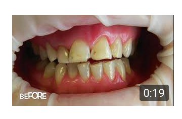 Rdent2's tweet photo. Before & After at #Rdent #Galway #SayItSmiling #CosmeticDentistry
https://t.co/iWErJlINHj https://t.co/HqhqDwCw1k