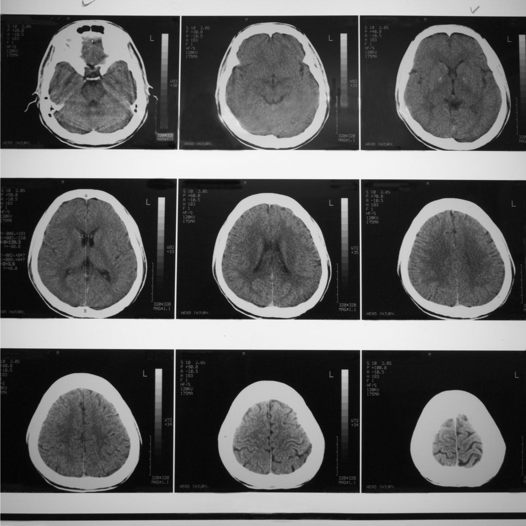 hitresetorg's tweet photo. Brain injuries aren’t just a concern for athletes. Abuse survivors should be thinking about their brain health too. https://t.co/f9E7aTlHnW https://t.co/VsNjM5Mx58