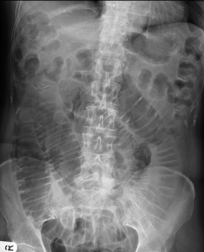 BHD_GI_LIVER's tweet photo. Small Bowel Ileus https://t.co/bGMtuAgWvK