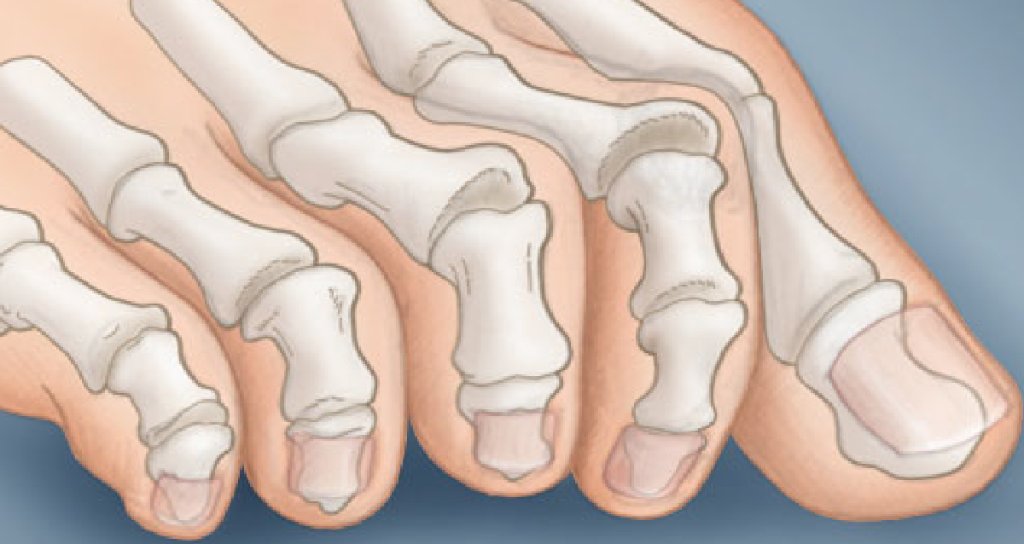 WebMD's tweet photo. Claw toes can be caused by too-tight shoes that pinch your toes or by a disease that damages nerves. More info: https://t.co/J7T4O3Ok4V https://t.co/JiWp7fsfa4