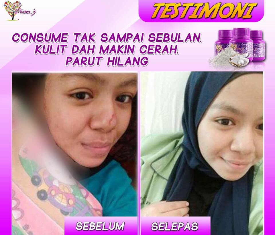 dianz_vit's tweet photo. yang nak hilangkan jerawat, jeragat, parut lama, exzema, putihkan kulit boleh guna #dianz vit. mmg tak rugi.
📱 : https://t.co/xusRK0abCd https://t.co/HsDnyknO4p