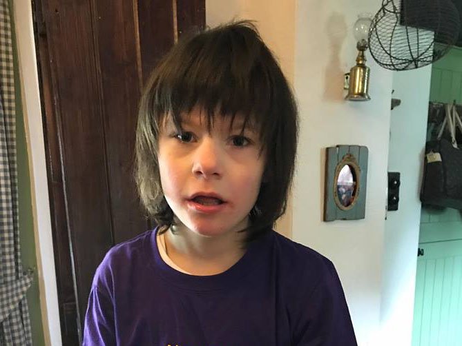 uoftcpd's tweet photo. From 100 seizures/day to 250 days seizure free. Cannabinoids in #Epilepsy #ChildDev2017 https://t.co/ZHWEDxtTJ8 https://t.co/0F8qwY2SWe
