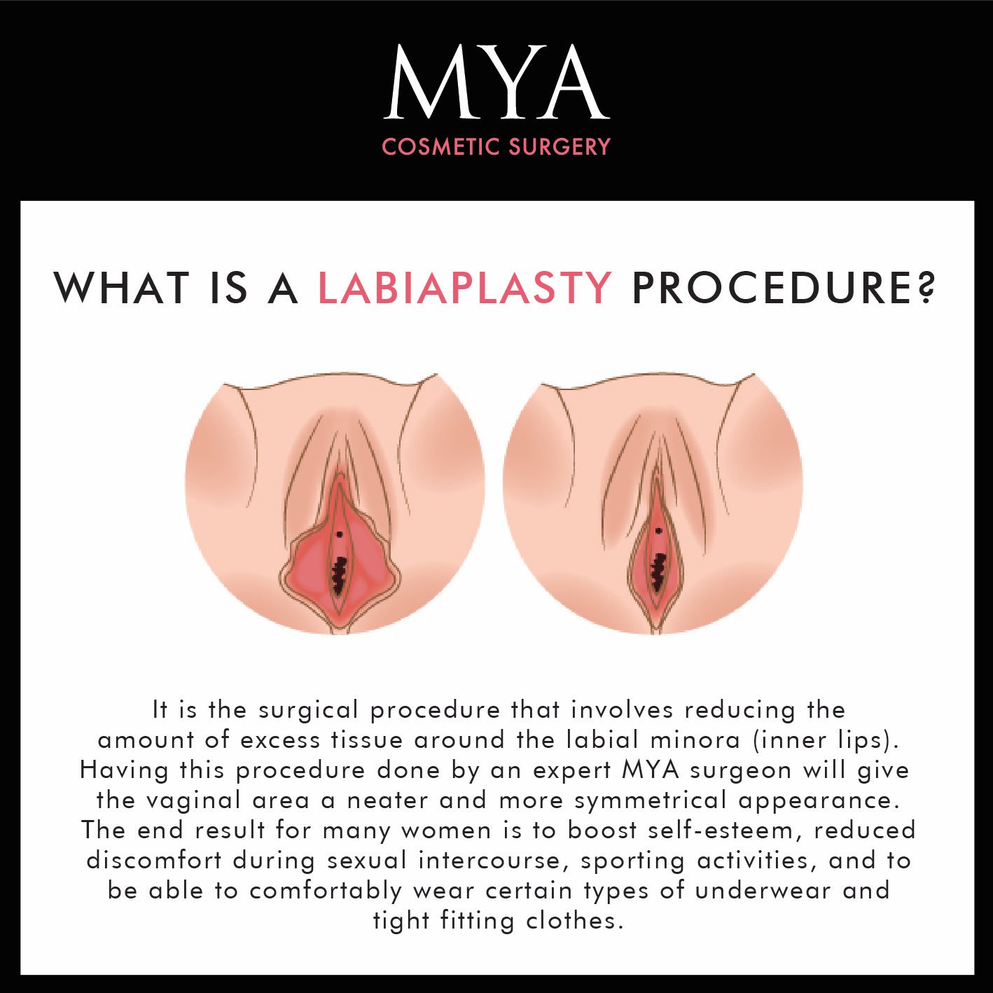 labiaplasty