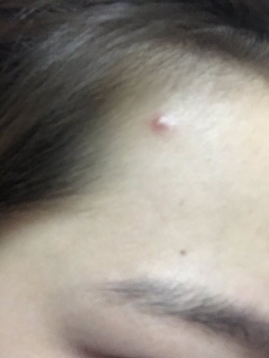 Iamaomam_'s tweet photo. คืนเดียวรู้เรื่อง จากสิวที่กำลังอักเสบอยู่ตื่นมาก็ยุบลงจ้า คือตกใจมากเป็นเจลบำรุงที่เริ่ดสุดๆ 180฿เองไปตำใช้ได้นานมากๆ  #ใช้จริงรีวิวจริง https://t.co/0Nzr718XBm