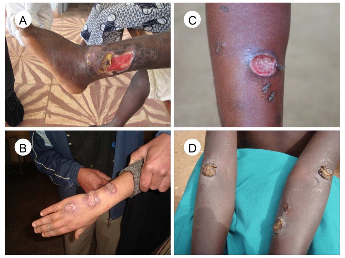 ControlScabies's tweet photo. #COR_NTD17 Skin #NTD breakout - references for integration 1: @oriolmitja et al @PLOSNTDs https://t.co/v6aYeu1bG9 https://t.co/IjZWwrW5m6