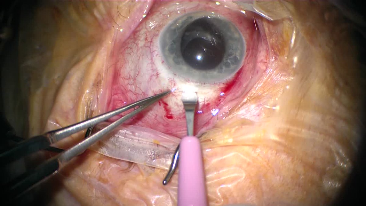 eyetubenet's tweet image. Considering a fellowship in #vitreoretinal surgery? Here's everything you'll learn according to Murtaza Adam, MD hubs.ly/H09cR-b0