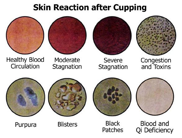 _cupping_clinic's tweet photo. Skin reaction's after cupping.
#detox #painrelief #stressfree #health #remedy #regulatehormones #fertility #acnefree #clearskin #weightloss #migrains #backpain https://t.co/HaxYpEQZzp