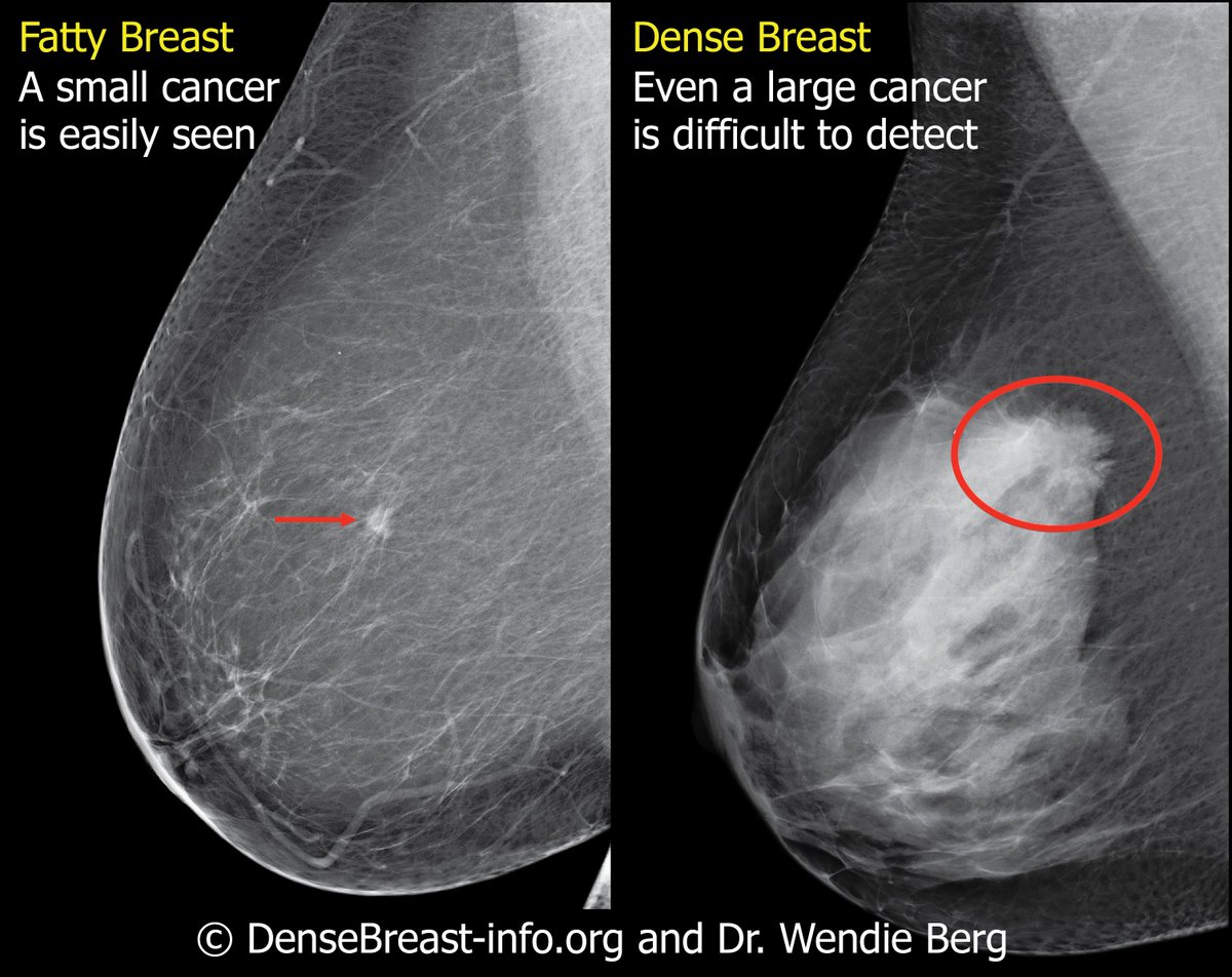 DenseBreastInfo's tweet photo. .How breast density can compromise cancer detection on a mammogram. In a fatty breast a small cancer is easily seen, in dense breast even a large cancer difficult to detect. Visit https://t.co/8h14LphGPb to learn more https://t.co/X4h7AUyHWv
