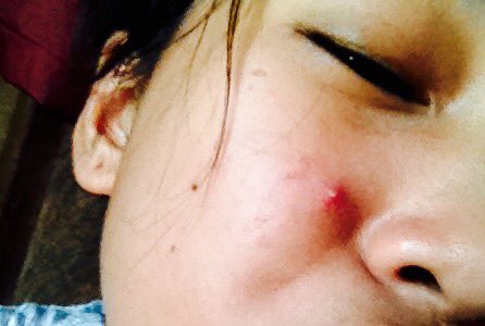 Xxtin12's tweet photo. @FTTMph Kapag yung Girl Pimple mong malandi nakakakita ng Boy Pimple.
*Namumula*
Kinabukasan may sandosenang anak na yan sa mukha mo. Malandee 
#FFTM https://t.co/Js2fQC2sWa