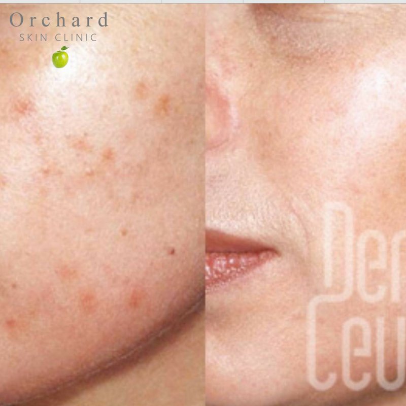 OrchardSkin's tweet photo. Try our micro-needling #treatment for #acne scars. It is clinically proven to be safe and effective. https://t.co/ZGPzjsBbxZ