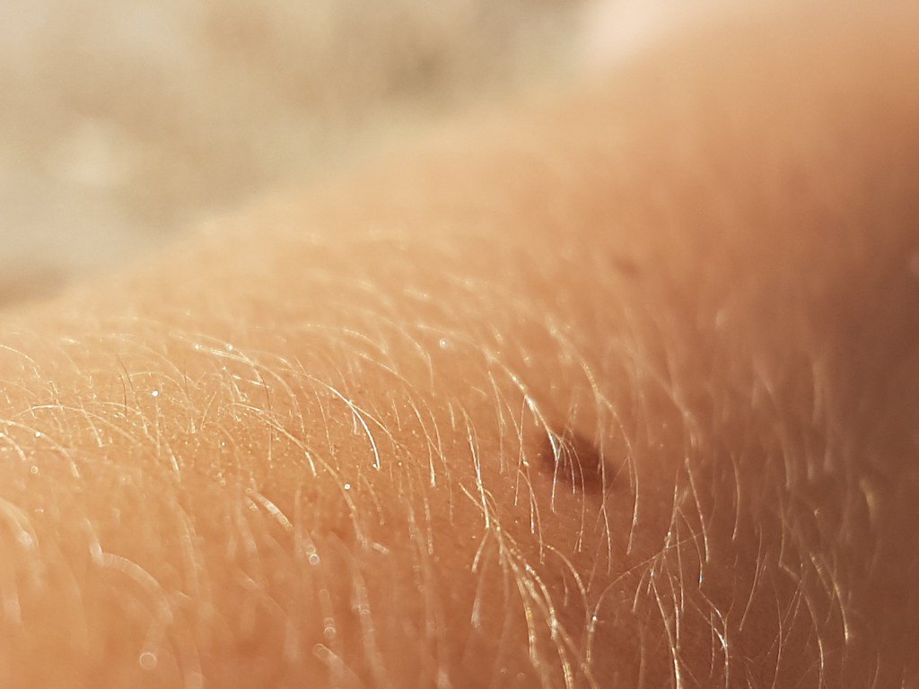 sugarcarein's tweet photo. Your skin might talk about your high blood sugar levels https://t.co/YEWsa85cLR https://t.co/jCrmC0EmDr